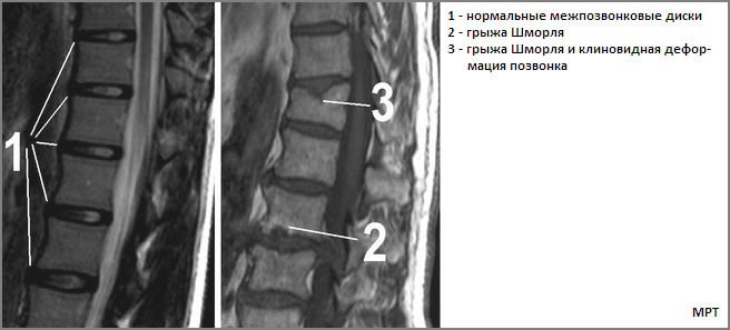 Грыжа шморля что это фото
