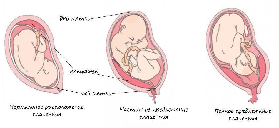 13 неделе беременности плацента. 7мм предлежание плаценты. Полная отслойка предлежащей плаценты. Плацента и внутренний зев. Предлежание плаценты классификация по УЗИ.